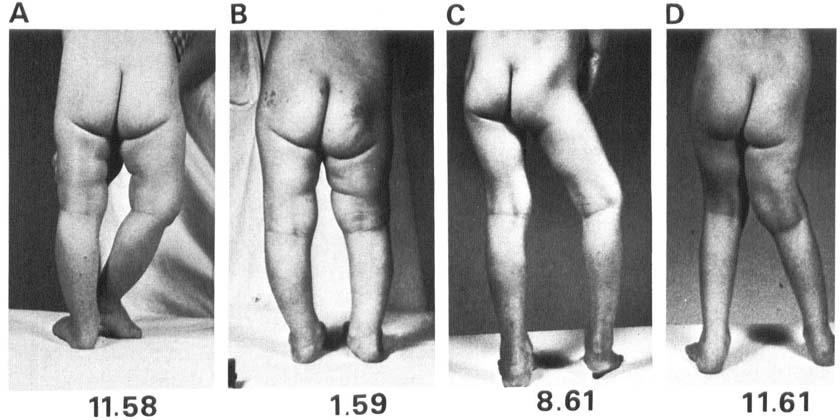 Growth disturbances after infantile osteomyelitis 7 Figure 7. Case 5. Photographs. A) Age 1 yr 2 rno before first osteotorny, B) Age 1 yr 4 rno, 6 weeks after osteotorny. C) Age 4 yrs.