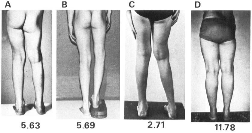 one case (case 4) the history of gradually appearing deformity was given at age 2 years and in another (case 2) more than 3 years after the acute stage.