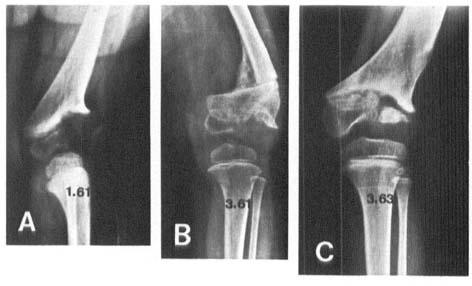 8 A. Langenskiold Figure 9. Case 6. AP radiographs. A) Age 2 yrs, 3) Age 2 yrs 2 mo. State 7 weeks after first osteotomy. C) Age 4 yrs 1 mo.