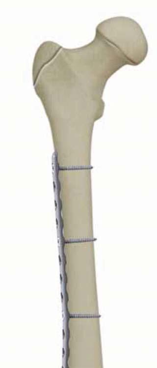 Product Overview The PediLoc Contour Femur Plate was designed to adhere to the principles of internal fixation: the femur of a child, aiding the surgeon in anatomic reduction.