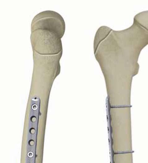 Pre-Operative Planning you need the diaphyseal/bowed femur plate