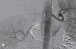 stenosis of left renal artery.