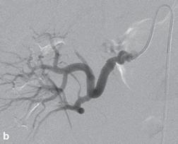 Catheter directed renal angiography