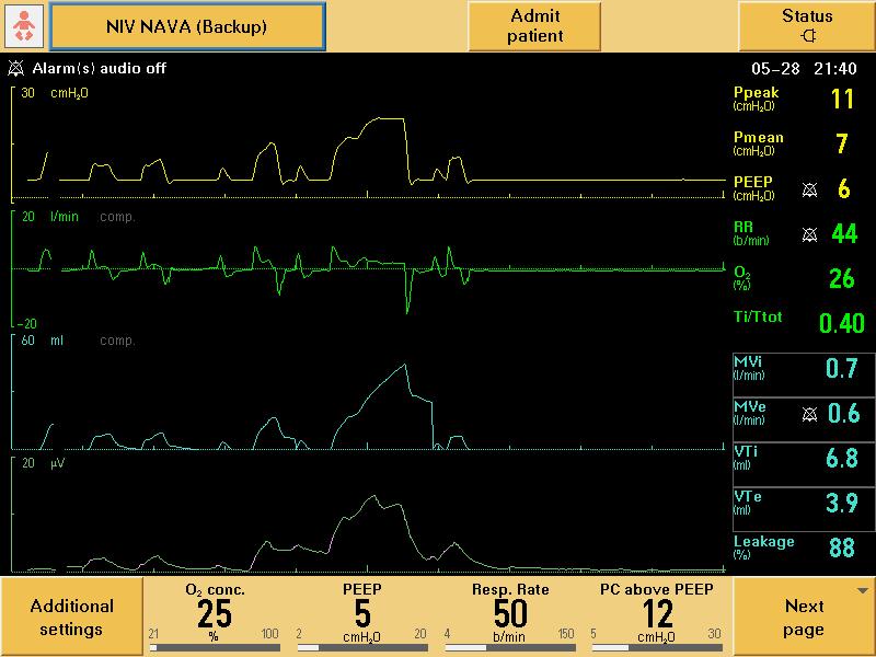 Knowing the Correct NAVA Level Knowing the Correct NAVA Level Normal Edi Peak = 5 15 mcv The higher the Edi Peak, the more the diaphragm is working.