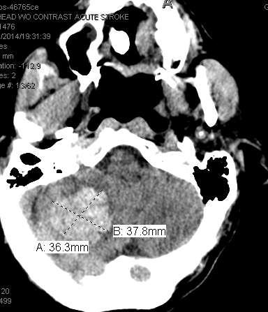 Case 82 years with h/o of HTN, a fib, lupus anticoagulant disorder, h/o of bladder and prostate cancer Large rt cerebellar hemorrhage. He received FEIBA And FFP to reverse his INR.