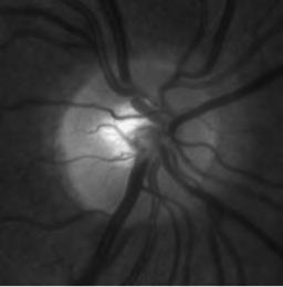 Case Example: Optic Neuritis A 30-year old woman presents with a 3-day history of vision loss in the left eye. She reports no other medical problems.