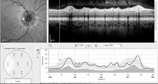 280 791). The patient was diagnosed with nutritional optic neuropathy. Oral B6, B12, and folate supplementation resulted in the patient s acuity improving to 20/30 OU.