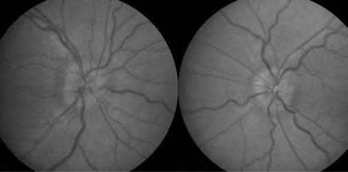 Fundus photographs of Case 2. Figure 4. Retinal nerve fiber layer of the optic nerves in Case 2 using spectral-domain OCT. visual obscurations. She was 5 ft tall and weighted 142 lbs (BMI = 27.