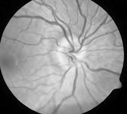 How to Distinguish Pseudopapilledema from Papilledema Anthony C. Arnold, MD Jules Stein Eye Institute UCLA Dept. of Ophthalmology Los Angeles, CA Learning Objectives 1.