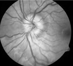 Describe the best use ancillary tests and tailor the investigative approach in patients with possible papilledema versus pseudo-papilledema CME Questions 1.