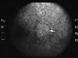 Figure 6 Fluorescein angiography has been studied as a tool to identify ODD and
