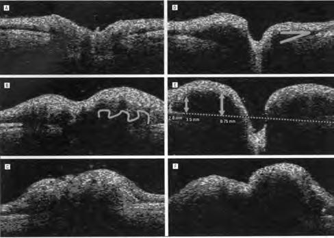 Fluorescein angiography is an accurate and reliable method of differentiating pseudopapilledema from papilledema References 1. Kurz-Levin M, Landau, K.