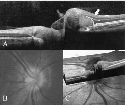 Surv Ophthalmol 21:375 390, 1977. 3. Kelley J. Autofluorescence of drusen of the optic nerve head. Arch Ophthalmol 92:263 264, 1974. 4. Sanders M, Ffytche, TJ.
