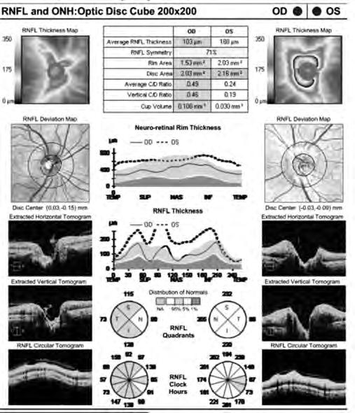 How to Best Measure Afferent Visual Pathway Damage in Neuro-ophthalmic Disorders the Optic Nerve, Retinal Nerve Fiber Layer, and Beyond!