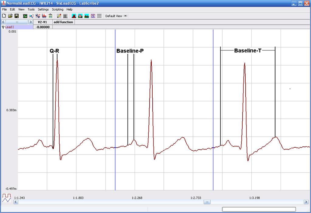 Figure HH-4-L4: ECG recording displayed in the Analysis window.