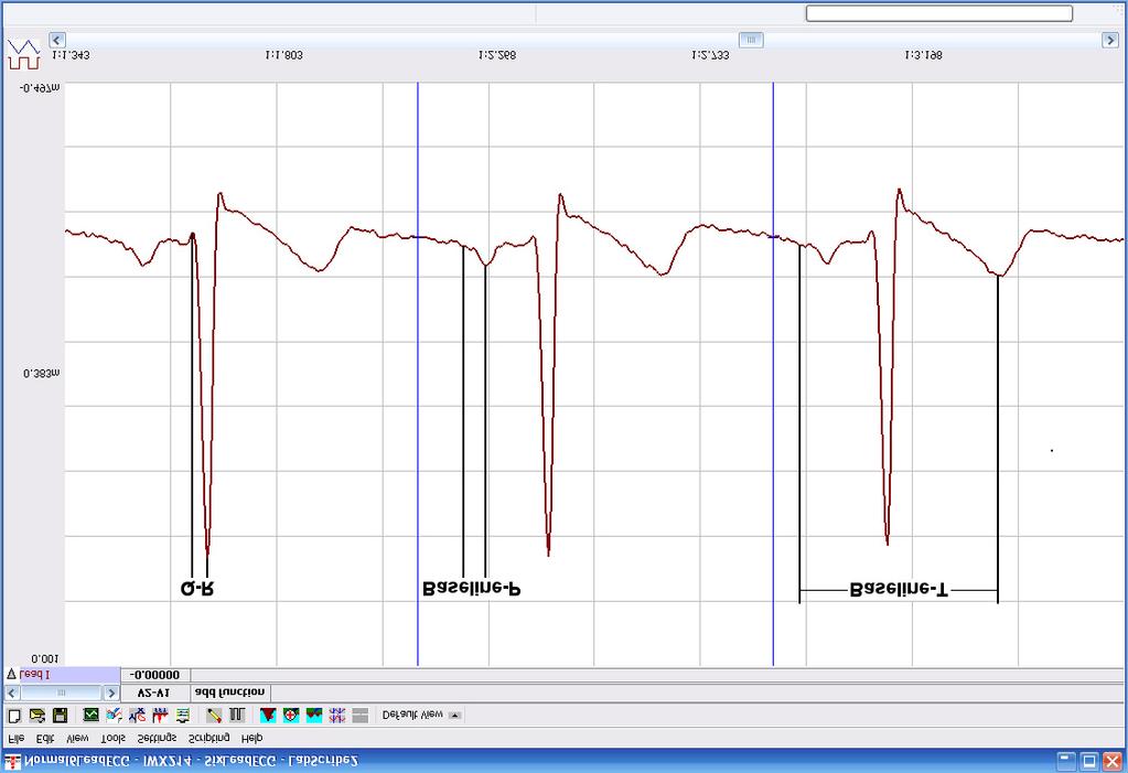 Figure HH-4-L4: ECG recording displayed in the Analysis window.