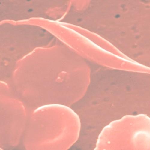 Overview In the about 12,500 people have Sickle Cell Disease (SCD) and it is now one of the most common inherited conditions in babies born in the.