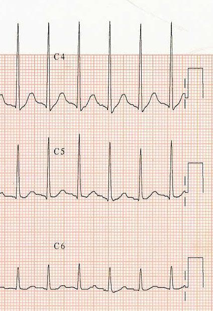 Message Hyperkalemia = Electrocardiogramm