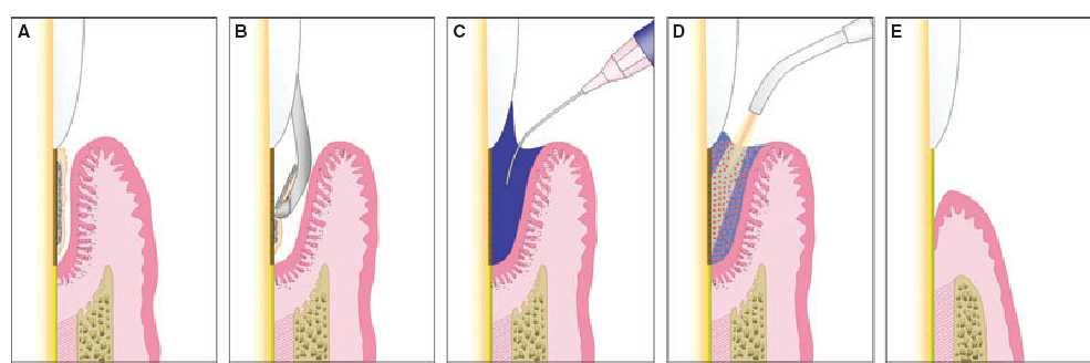 Figure 5: Steps of application of photodynamic therapy in the treatment of periodontitis. (A) Periodontally diseased site before treatment. (B) Mechanical debridement using hand curettes.