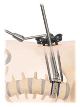 0 Timberline MPF Lateral System Surgical Technique Guide OPTIONAL ANGLED INSTRUMENTATION