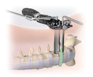 Timberline MPF Lateral System Surgical Technique Guide APPENDIX A HYPERLORDOTIC CONSIDERATIONS Anterior Longitudinal Ligament (ALL) Resection If the surgeon elects to partially or completely release