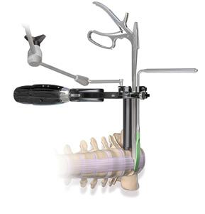 first identifying the ALL, and then carefully advancing the soft tissue retractor anterior to the ALL but posterior to the great vessels. The retractor should extend past the full width of the ALL.