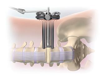 Timberline MPF Lateral System Surgical Technique Guide 5 APPENDIX A INSERTION AND SCREW HOLE PREPARATION