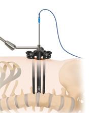 The Timberline retractor is utilized to create the desired exposure for implanting the Timberline MPF implant.