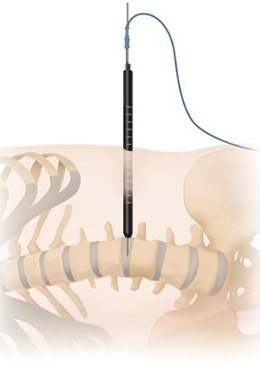 Timberline Lateral Fusion System Surgical Technique Guide 17 SECOND DILATOR INSERTION Figure 16 Second dilator placement STEP 19 If neuromonitoring is selected by the surgeon, keep the monopolar
