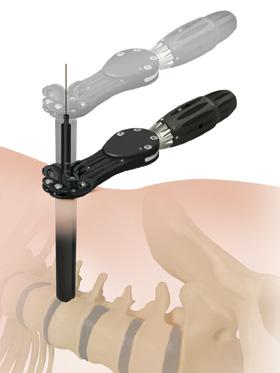 20 Timberline Lateral Fusion System Surgical Technique Guide RETRACTOR INSERTION ARTICULATING ARM PUTS DOWNWARD PRESSURE ON RETRACTOR TO ANTERIOR RAIL OF TABLE ATTACH HERE FOR ANTERIOR RETRACTION