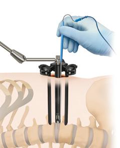 Timberline Lateral Fusion System Surgical Technique Guide 25 Figure 29 Ball-tip probe Figure 30 Blade lengthening and widening shims STEP 33