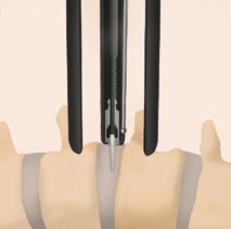 STEP 34 A psoas retractor or Penfield may be used to sweep away any tissue from the working channel.