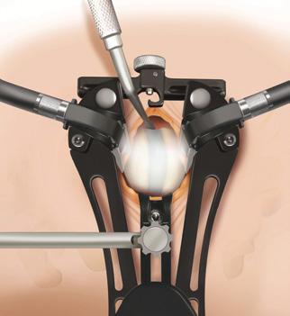 Timberline Lateral Fusion System Surgical Technique Guide 27 CORRECT ACCESS CONFIRMATION AND ANTERIOR BLADE ATTACHMENT Figure 33 Scoville with crossbar STEP 36 Confirm that the retractor has been