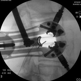 Lateral fluoroscopy can be used to confirm proper alignment of the templating instrument with the disc space. If desired, unlock the retractor handle and remove it from the retractor body.