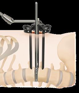 30 Timberline Lateral Fusion System Surgical Technique Guide IMPLANT SIZING