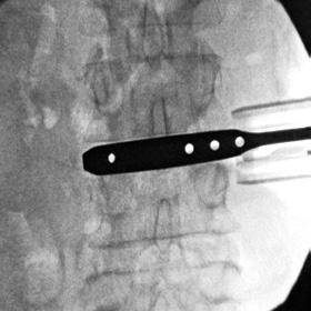 Implant length can be determined using the holes in the trial.
