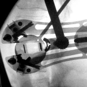 Fluoroscopy should be used to confirm correct implant placement.