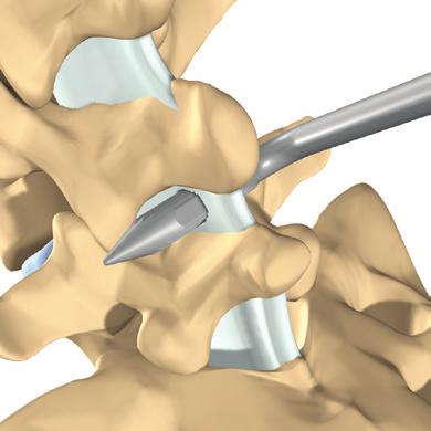 ligament Piercer-Rasp and puncture the interspinous ligament, placing it as far