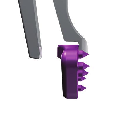 size. Introduce the implant, via the Cross Bar Plate Inserter, into the Spreader until the implant insert has been fully pushed