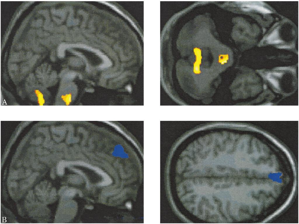 Figure 1. Essential blepharospasm (EB). (A) Brain regions associated with significant metabolic increases in EB in wakefulness.