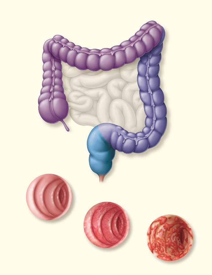 Figure 1: Ulcerative Colitis Classification From just above the anus to beyond the level of the spleen Transverse colon Splenic flexure Ascending (right) colon From just above the anus to level
