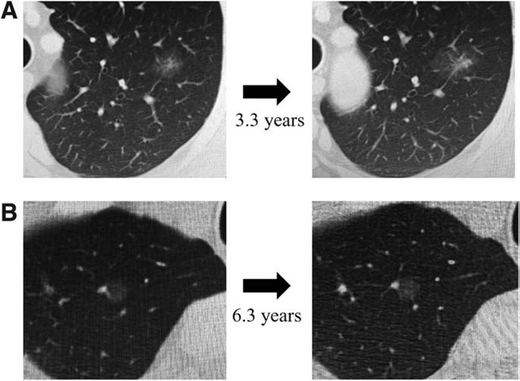 Journal of Thoracic Oncology Volume 8, Number 3, March 2013 Follow-up Period of Ground-Glass Opacity FIGURE 1. Computed tomography images of two representative pulmonary nodules with GGO.