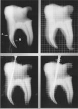 Rotary instruments and removal of root fillings 97 tor. The teeth were again placed on the radiographic mount and a millimetered radiograph was taken.