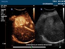 Reason #5 Reach a new level of diagnosis. Whole body contrast-enhanced ultrasound.