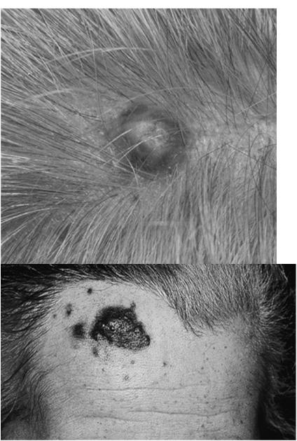 Malignant Blue Nevus Rare tumor of dermal melanocytes Most commonly arise in a cellular blue nevus; also within nevus of Ota or Ito, or de novo Scalp most