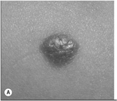 Spitz nevi Red or pigmented papule or nodule, avg 8mm Can mimic melanoma clinically and