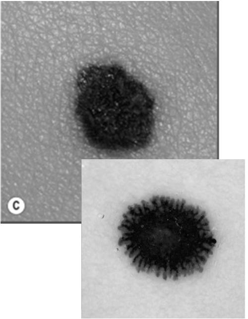 Dark brown to black macule or papule, usually <6mm Found in children or young adults Most common