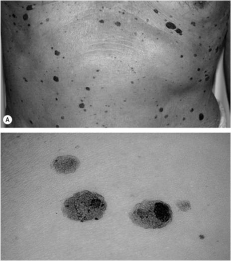 Seborrheic keratoses Appear 4 th decade of life Can be anywhere excepth mucous membranes, palms and soles Tan to black, macular, papular or verrucous lesions; waxy