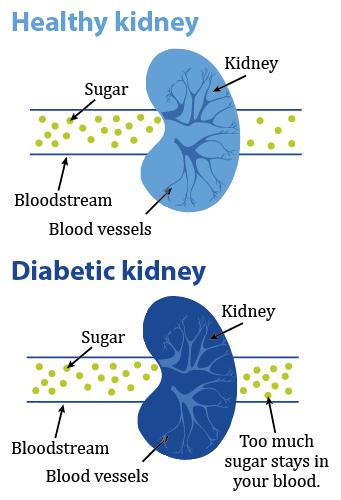 causes the kidneys to work too hard to remove excess sugar in the blood.
