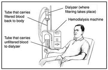 Hemodialysis Uses a machine to clean the blood Can be done in a dialysis center or at home If done in a dialysis center, treatments